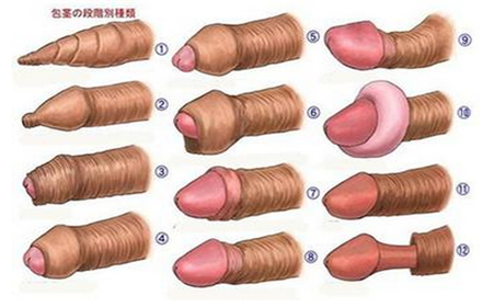 早泄患者的日常生活要注意什么<