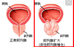 前列腺增生的危害大吗<